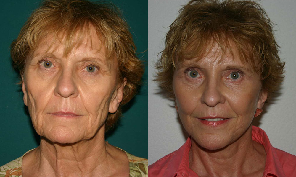 Antes y después Face Lifting Carlos Barrera
