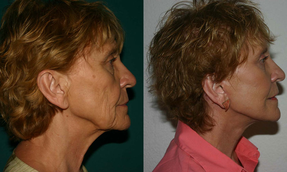 Antes y después Face Lifting Carlos Barrera