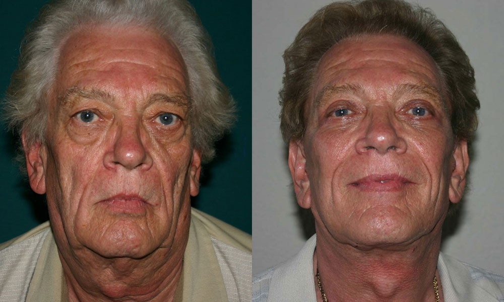 Antes y después Face Lifting Carlos Barrera