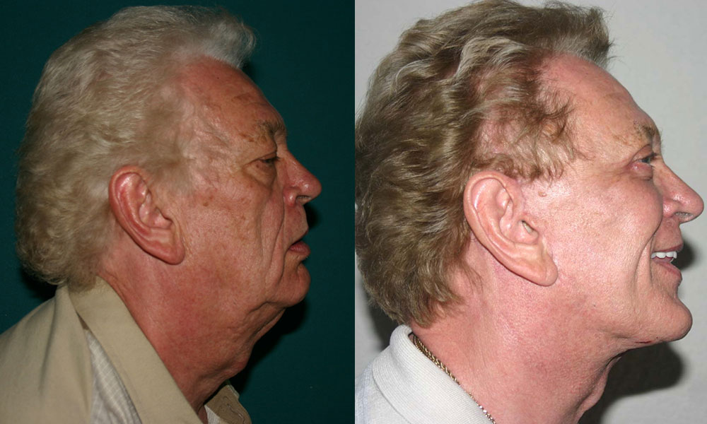Antes y después Face Lifting Carlos Barrera
