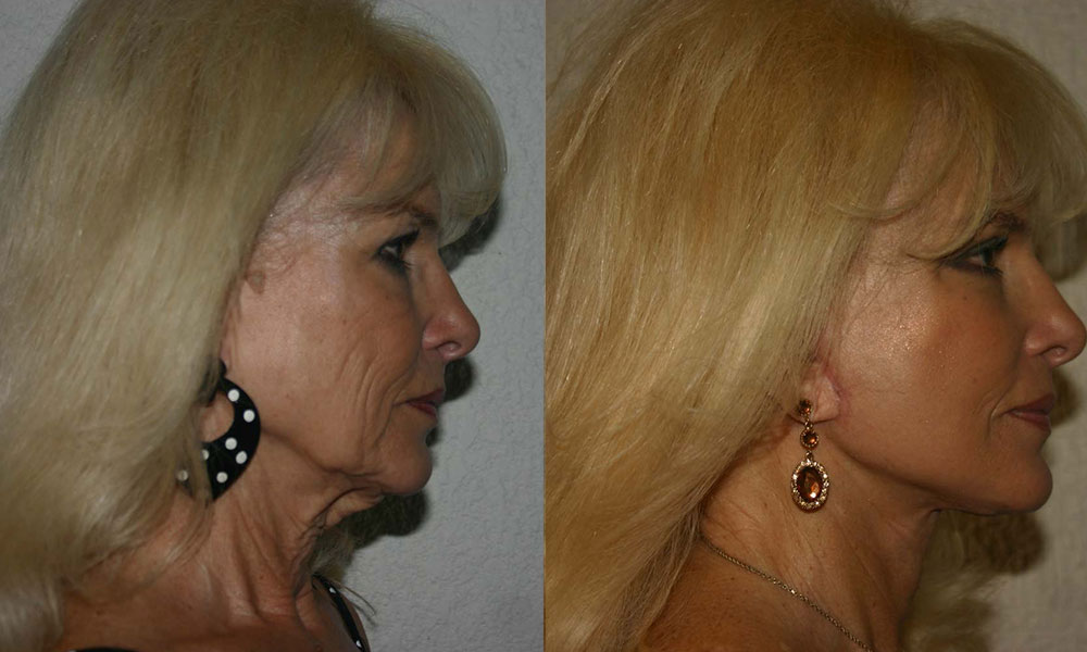 Antes y después Face Lifting Carlos Barrera