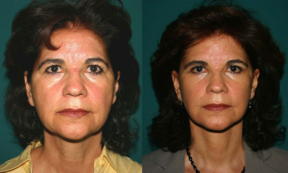 Antes y después Face Lifting Carlos Barrera