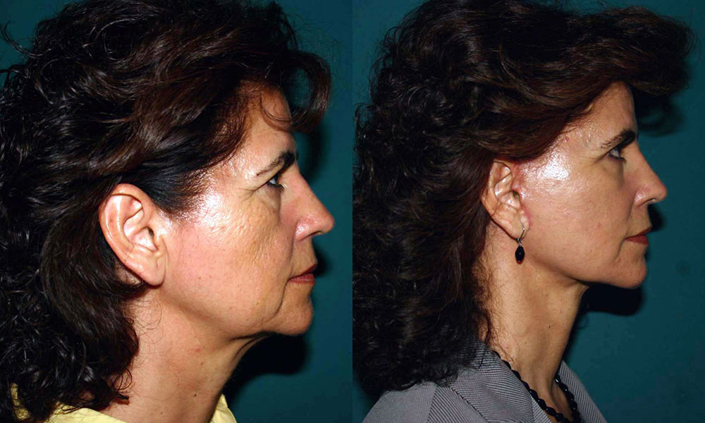 Antes y después Face Lifting Carlos Barrera