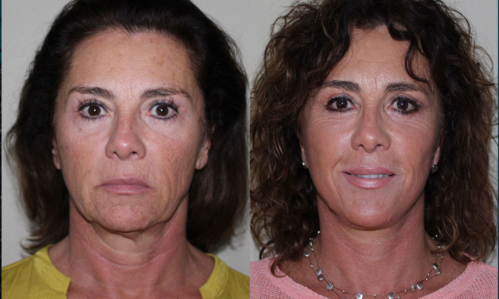 Antes y después Face Lifting Carlos Barrera