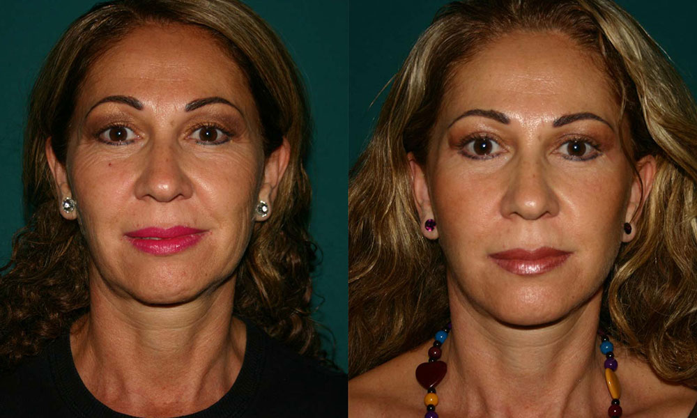 Antes y después Face Lifting Carlos Barrera