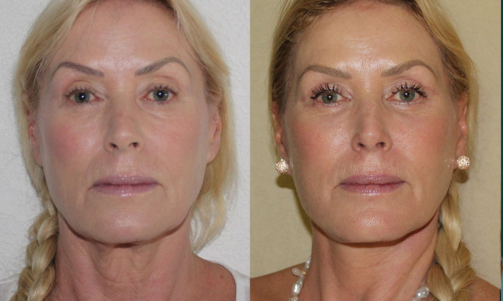 Antes y después Face Lifting Carlos Barrera