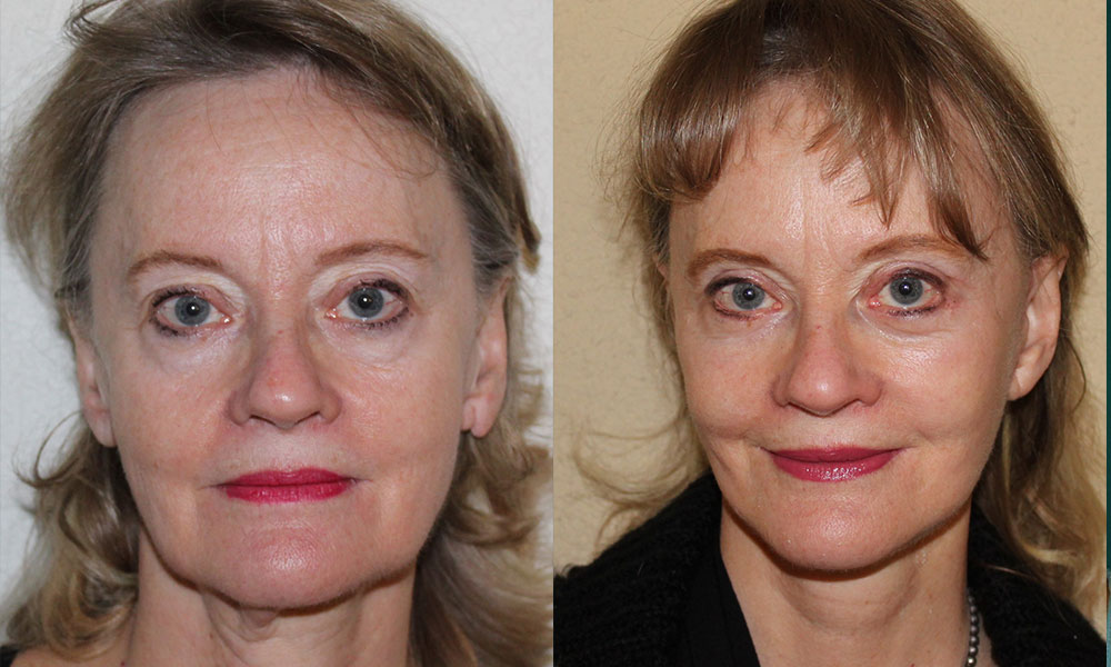 Antes y después Face Lifting Carlos Barrera