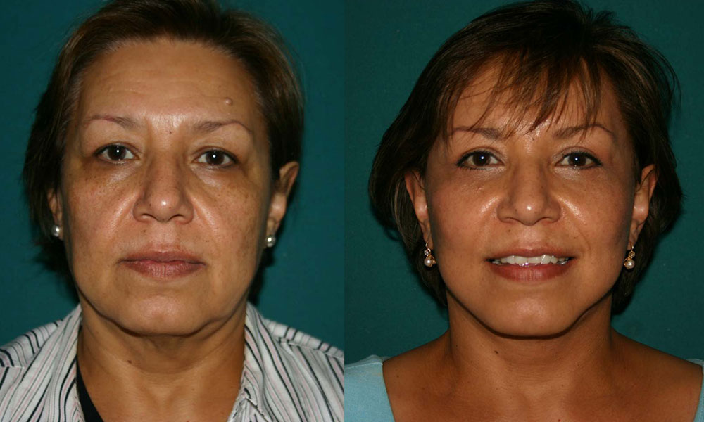 Antes y después Face Lifting Carlos Barrera