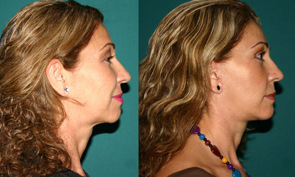 Antes y después Face Lifting Carlos Barrera
