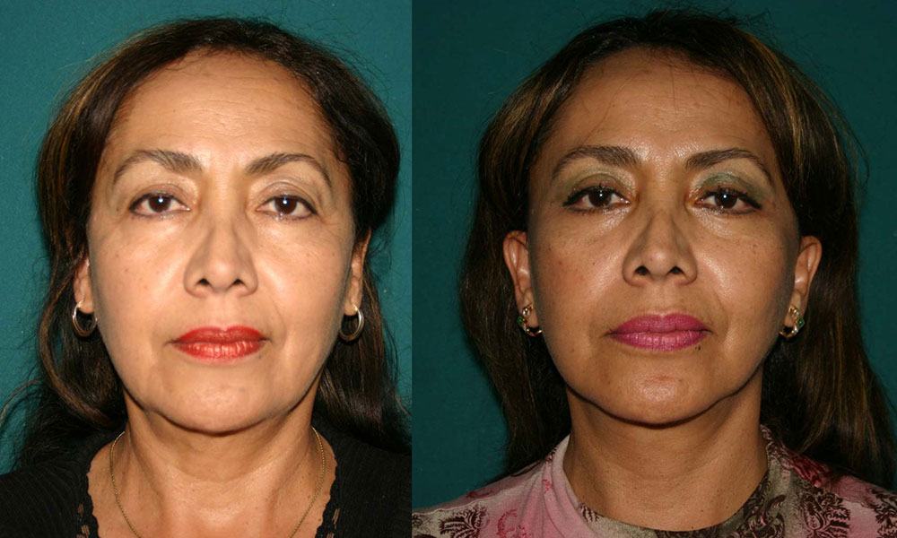 Antes y después Face Lifting Carlos Barrera