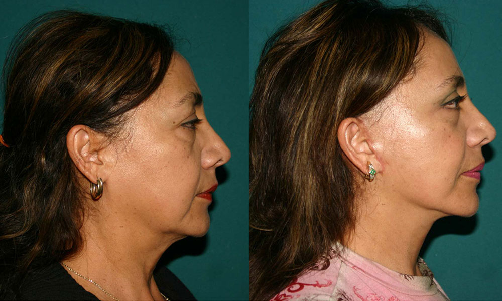 Antes y después Face Lifting Carlos Barrera