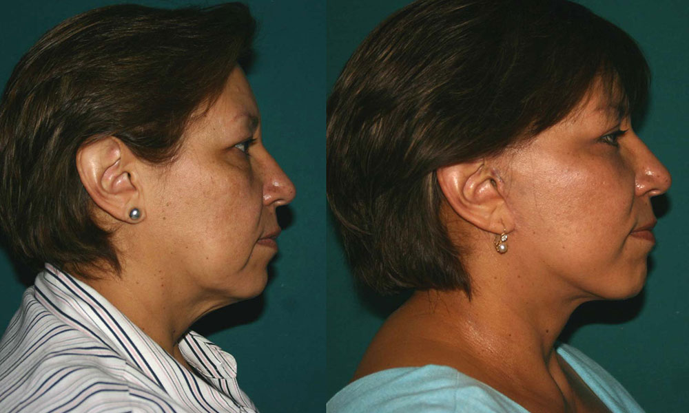 Antes y después Face Lifting Carlos Barrera