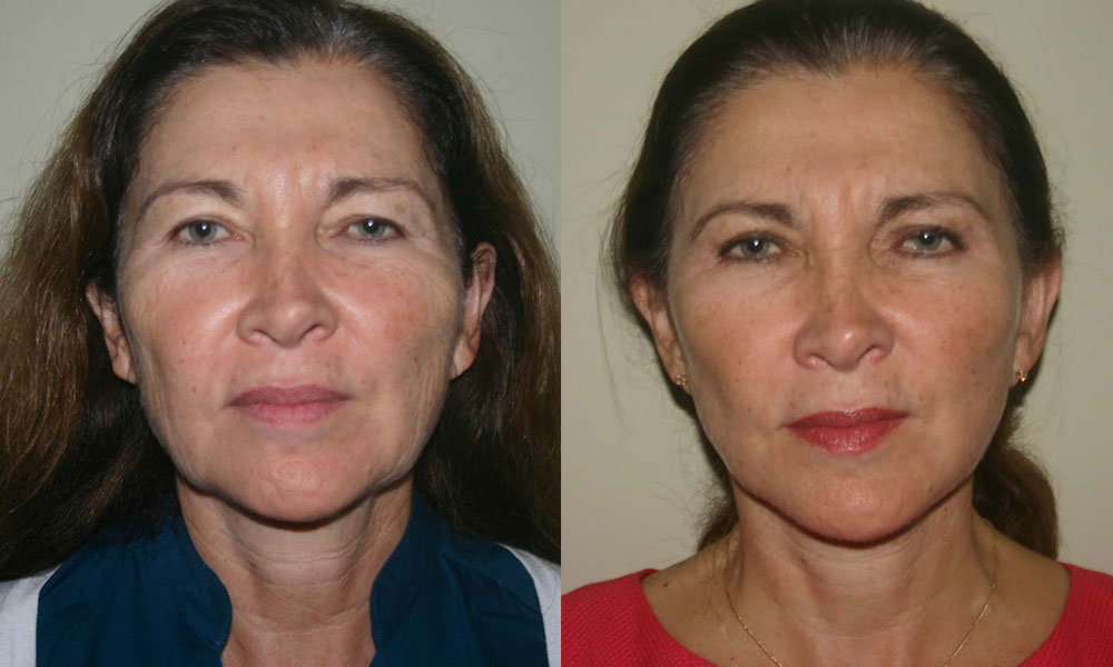 Antes y después Face Lifting Carlos Barrera