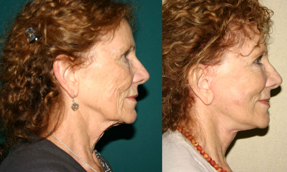 Antes y después Face Lifting Carlos Barrera