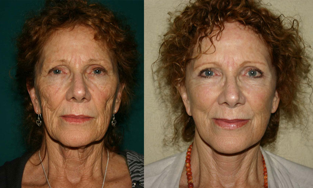 Antes y después Face Lifting Carlos Barrera
