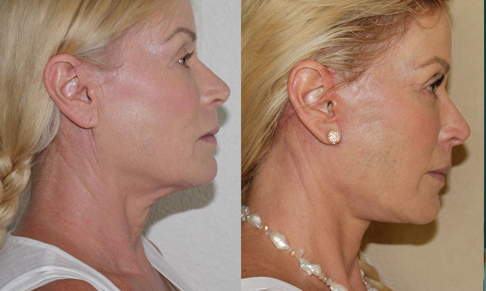 Antes y después Face Lifting Carlos Barrera