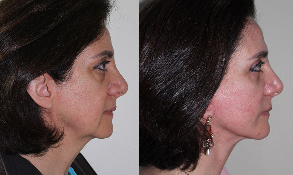 Antes y después Face Lifting Carlos Barrera