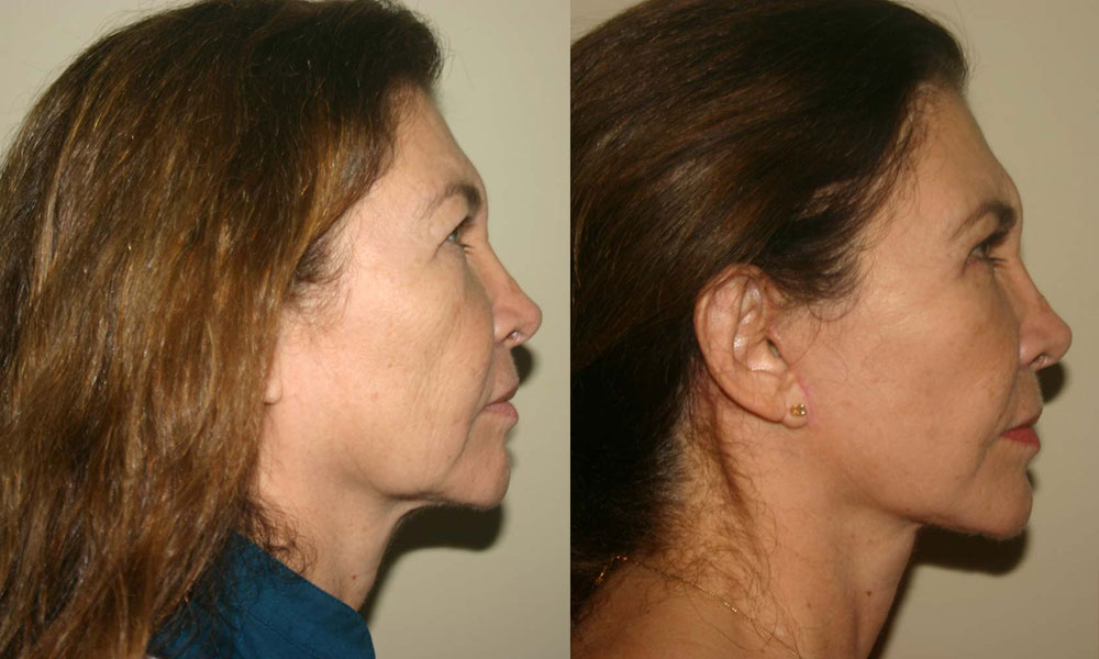 Antes y después Face Lifting Carlos Barrera