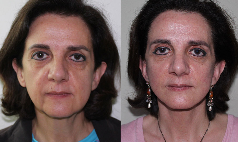 Antes y después Face Lifting Carlos Barrera