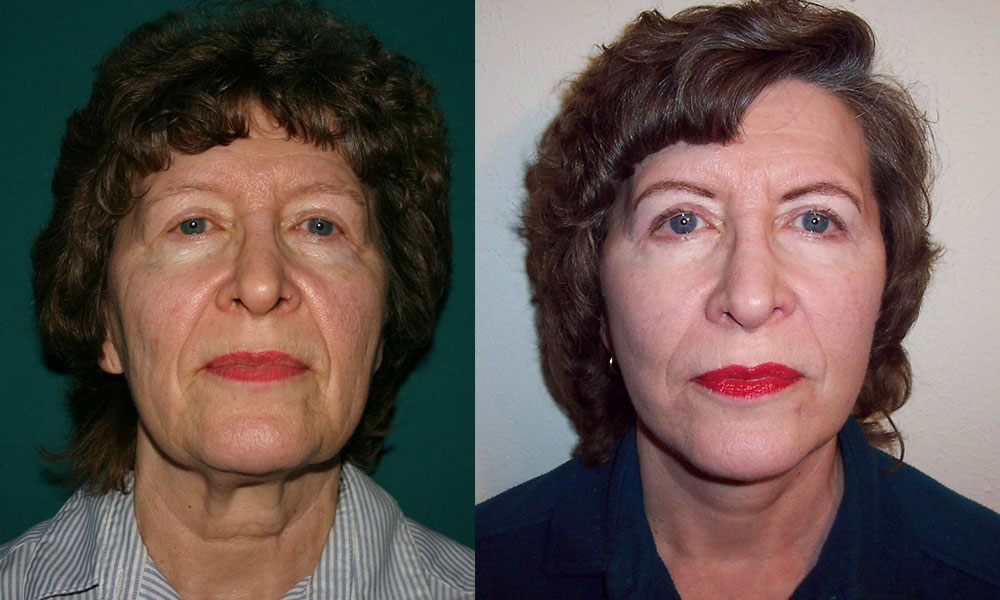 Antes y después Face Lifting Carlos Barrera