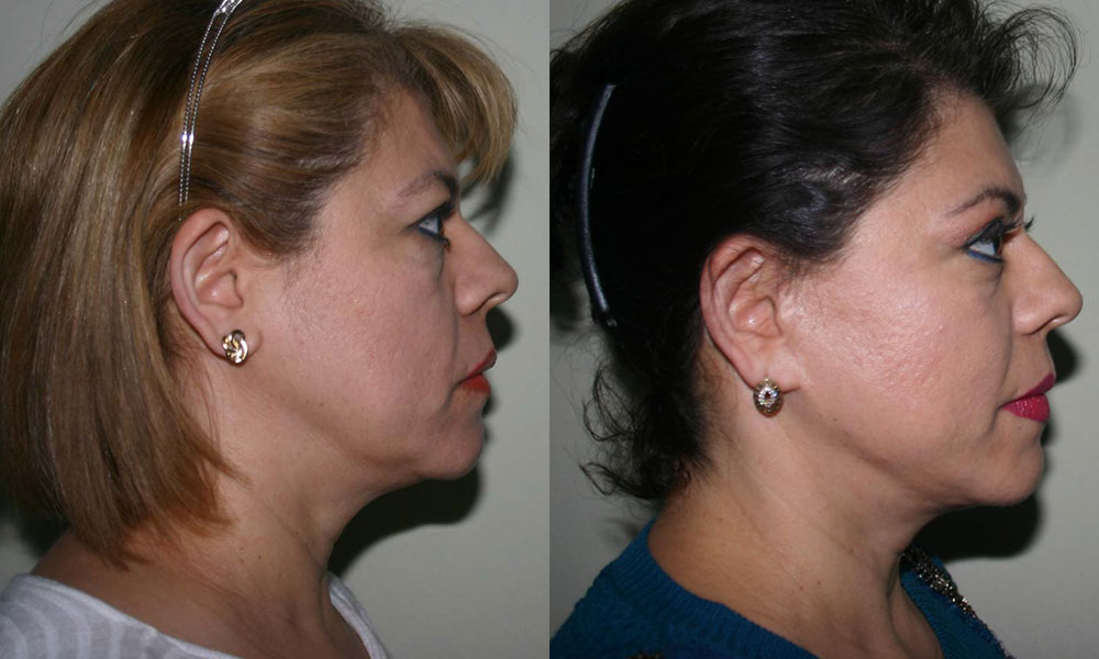 Antes y después Face Lifting Carlos Barrera
