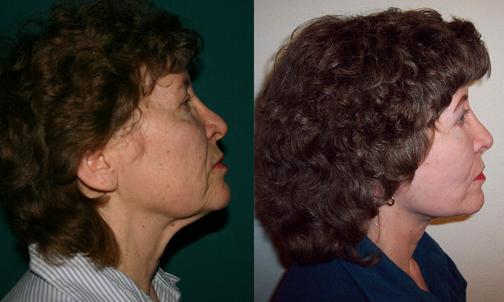 Antes y después Face Lifting Carlos Barrera