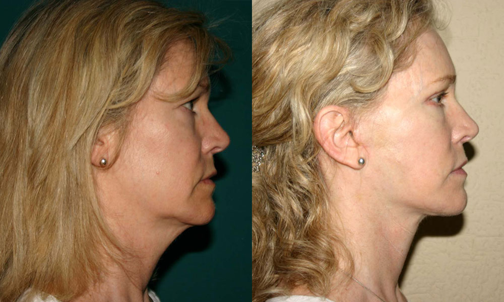 Antes y después Face Lifting Carlos Barrera