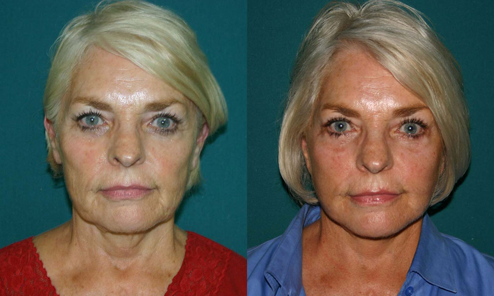 Antes y después Face Lifting Carlos Barrera