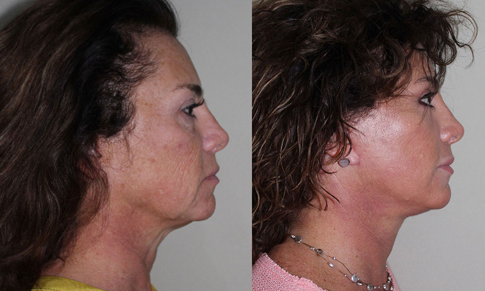 Antes y después Face Lifting Carlos Barrera