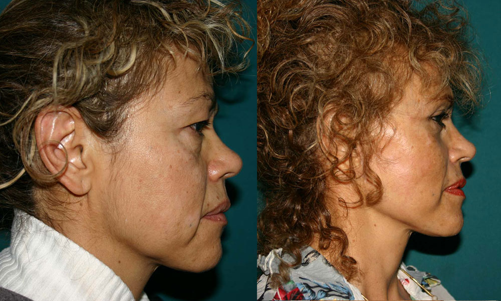 Antes y después Face Lifting Carlos Barrera