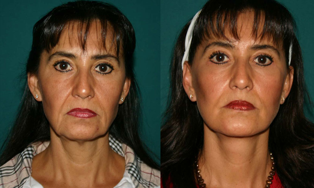 Antes y después Face Lifting Carlos Barrera