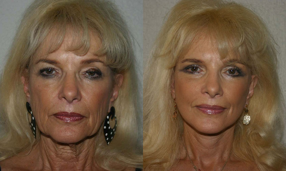 Antes y después Face Lifting Carlos Barrera