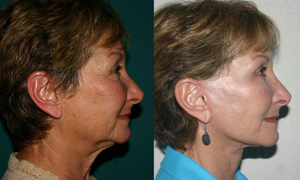 Antes y después Face Lifting Carlos Barrera