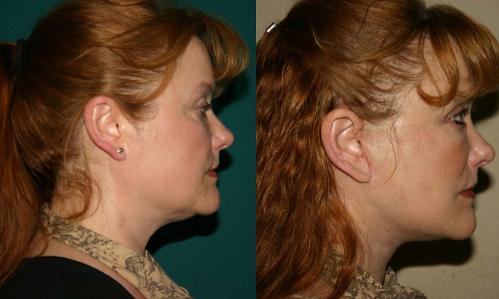 Antes y después Face Lifting Carlos Barrera