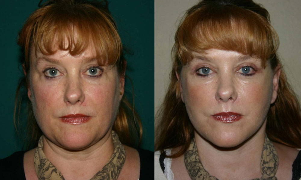 Antes y después Face Lifting Carlos Barrera