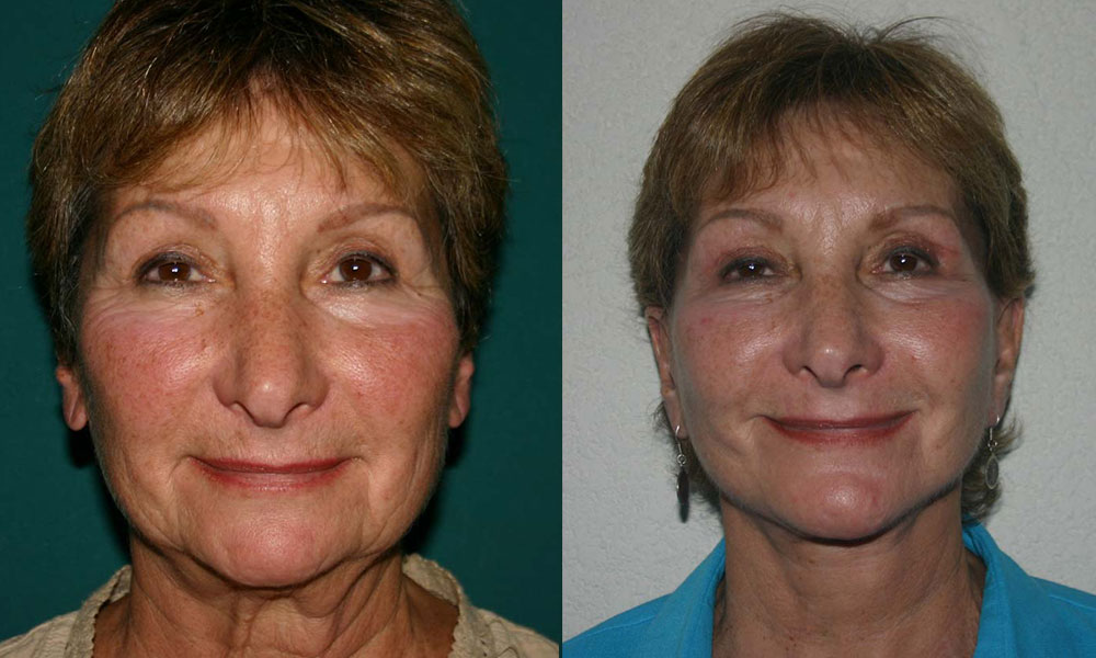 Antes y después Face Lifting Carlos Barrera