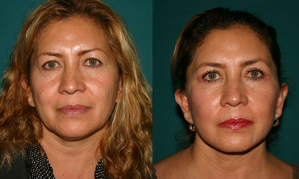 Antes y después Face Lifting Carlos Barrera