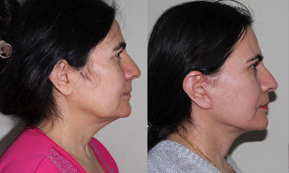 Antes y después Face Lifting Carlos Barrera
