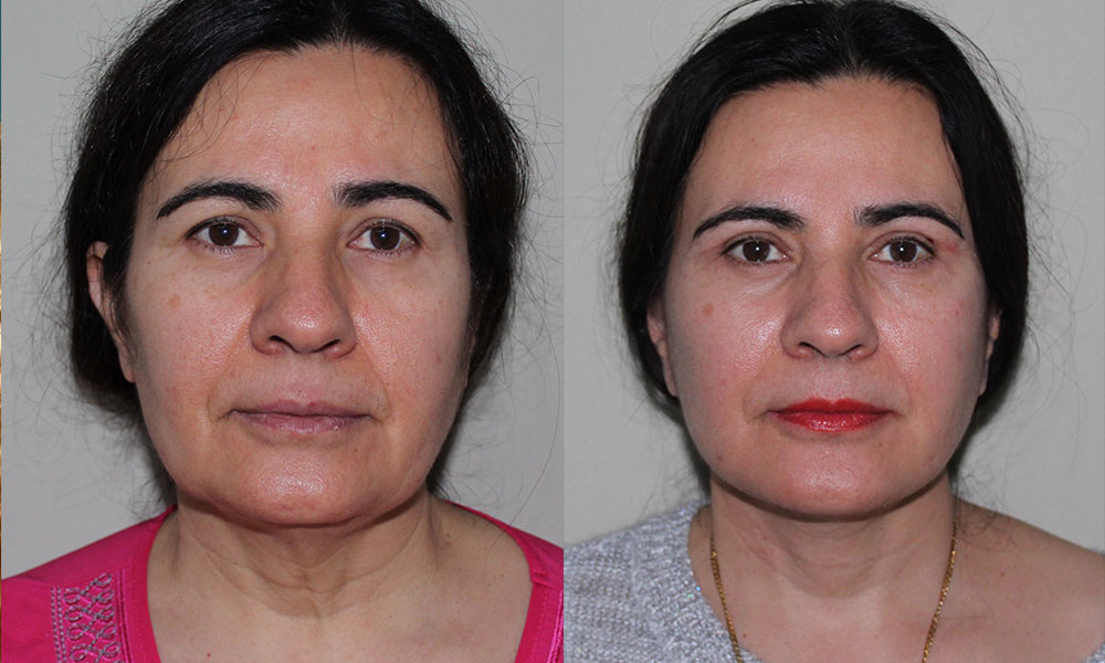 Antes y después Face Lifting Carlos Barrera