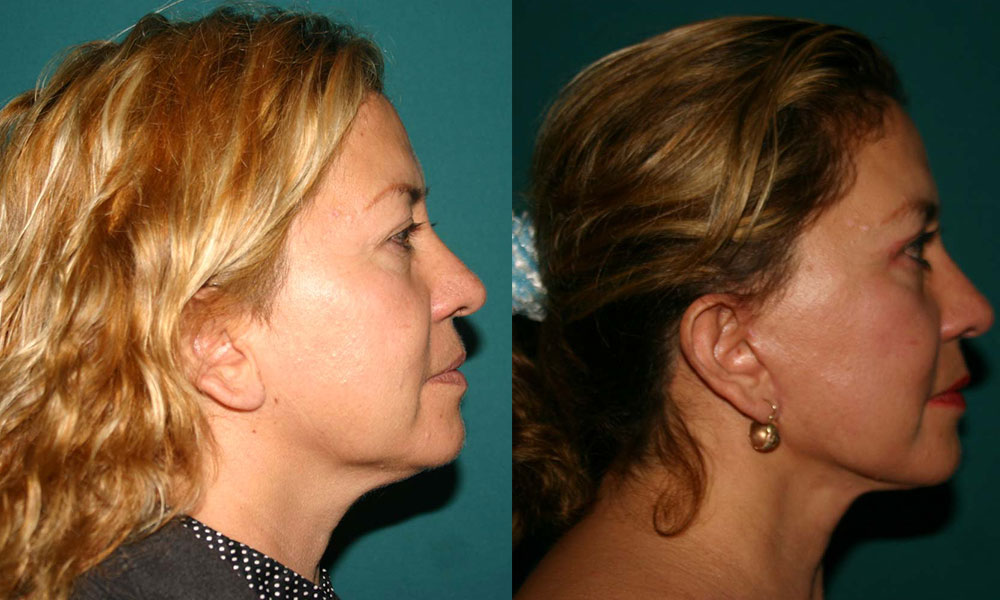 Antes y después Face Lifting Carlos Barrera