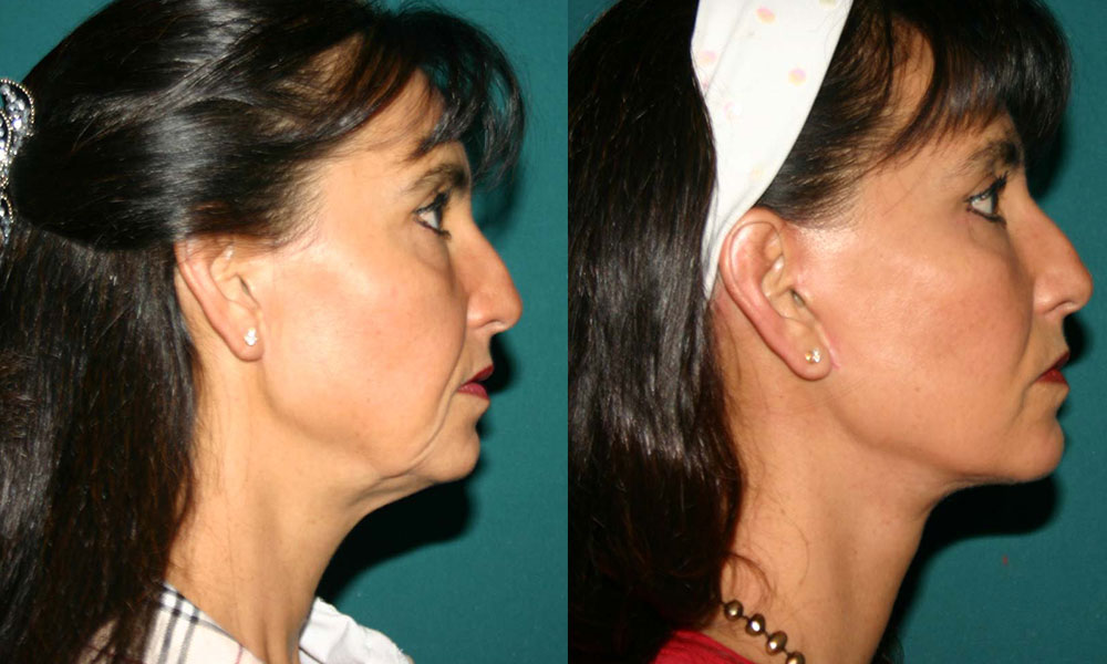Antes y después Face Lifting Carlos Barrera