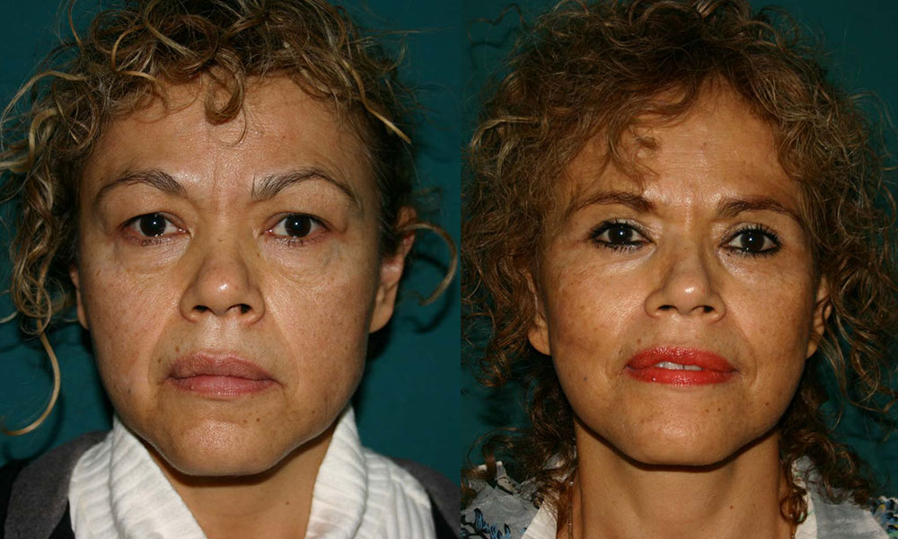 Antes y después Face Lifting Carlos Barrera